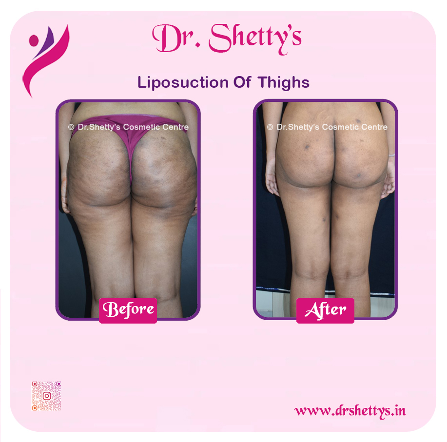 Thigh Lift Surgery 10