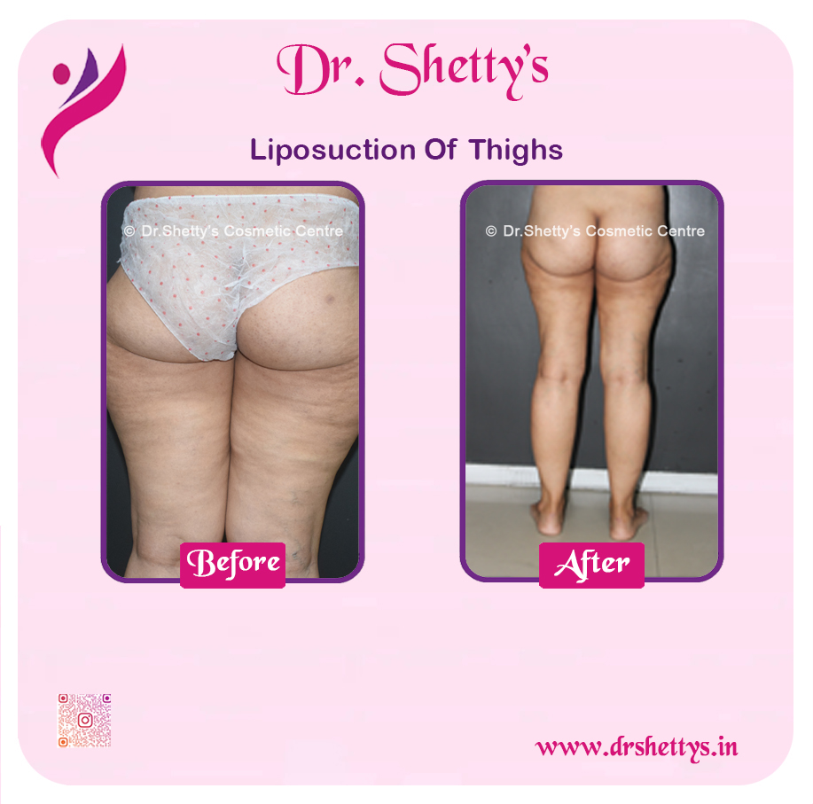 Thigh Lift Surgery 11