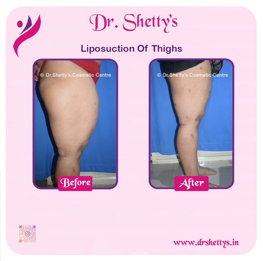 Thigh Lift Surgery 12