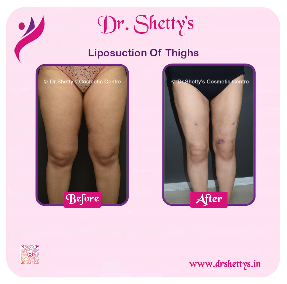 Thigh Lift Surgery 13