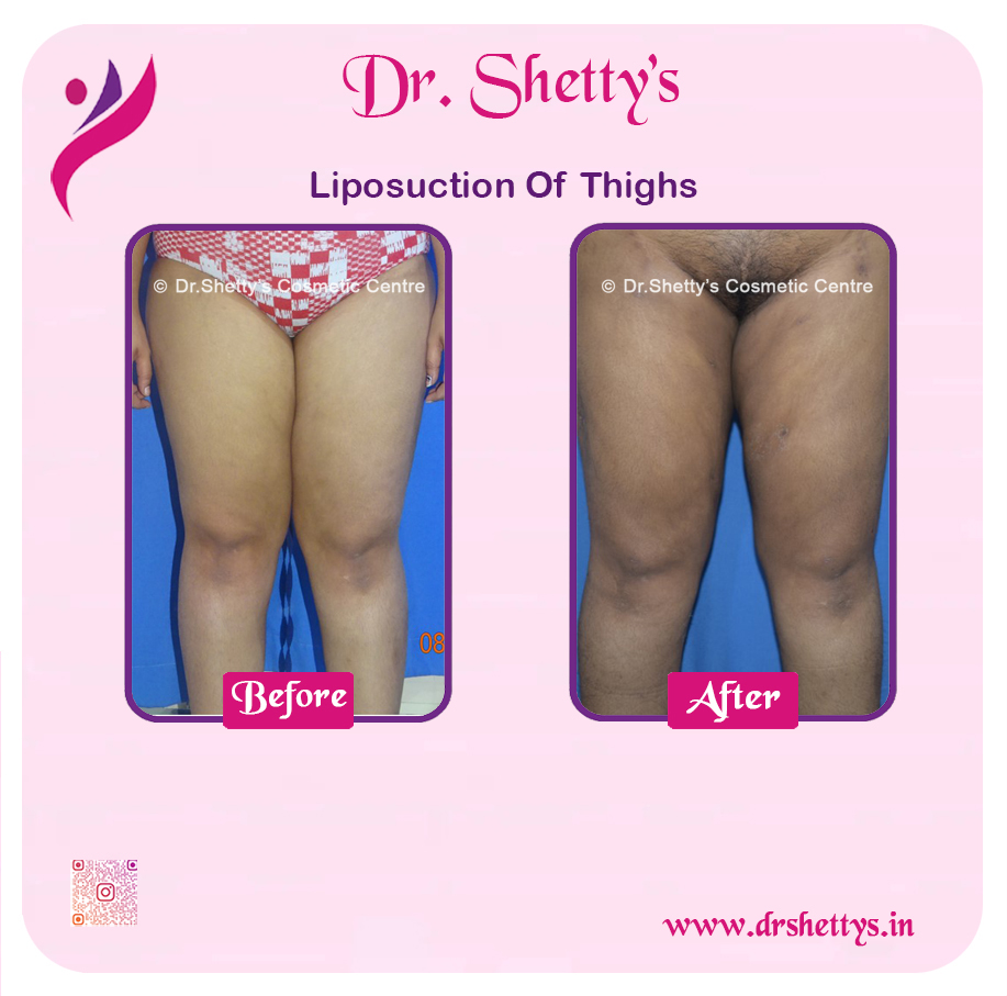 Thigh Lift Surgery 14