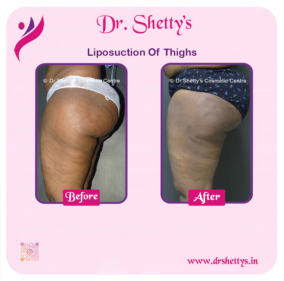 Thigh Lift Surgery 15
