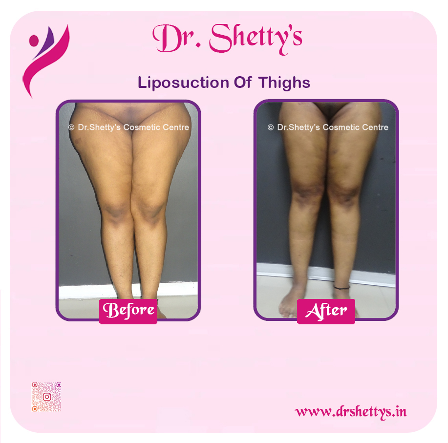 Thigh Lift Surgery 16