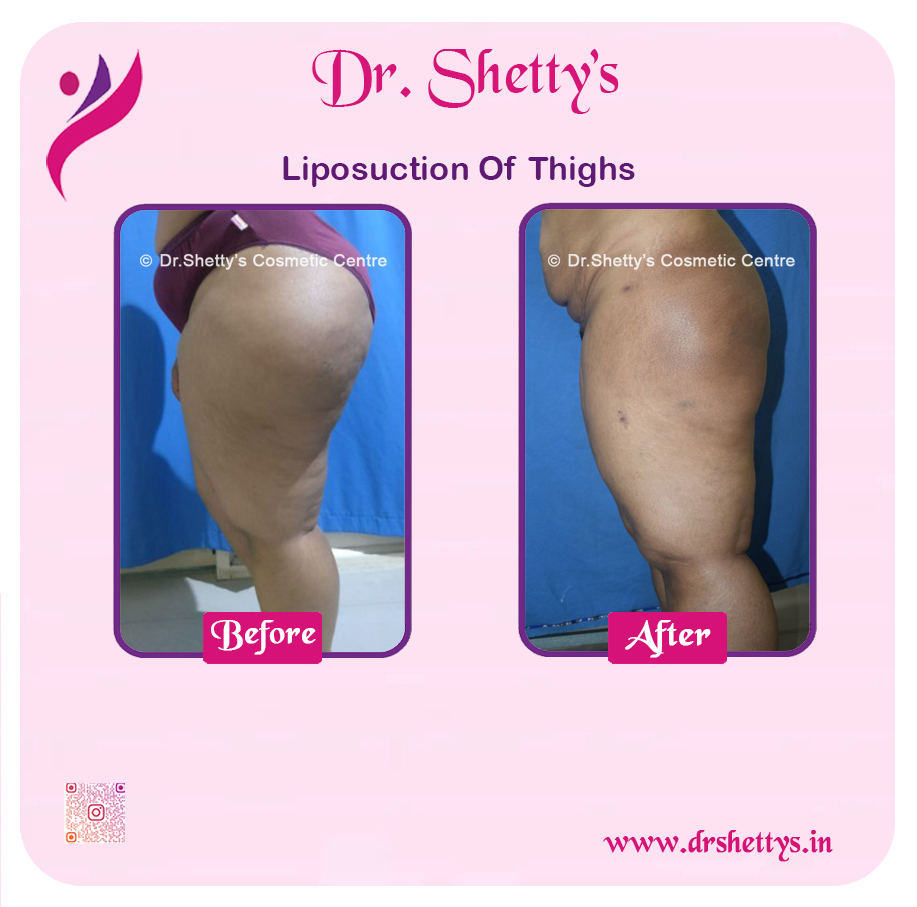 Thigh Lift Surgery 3
