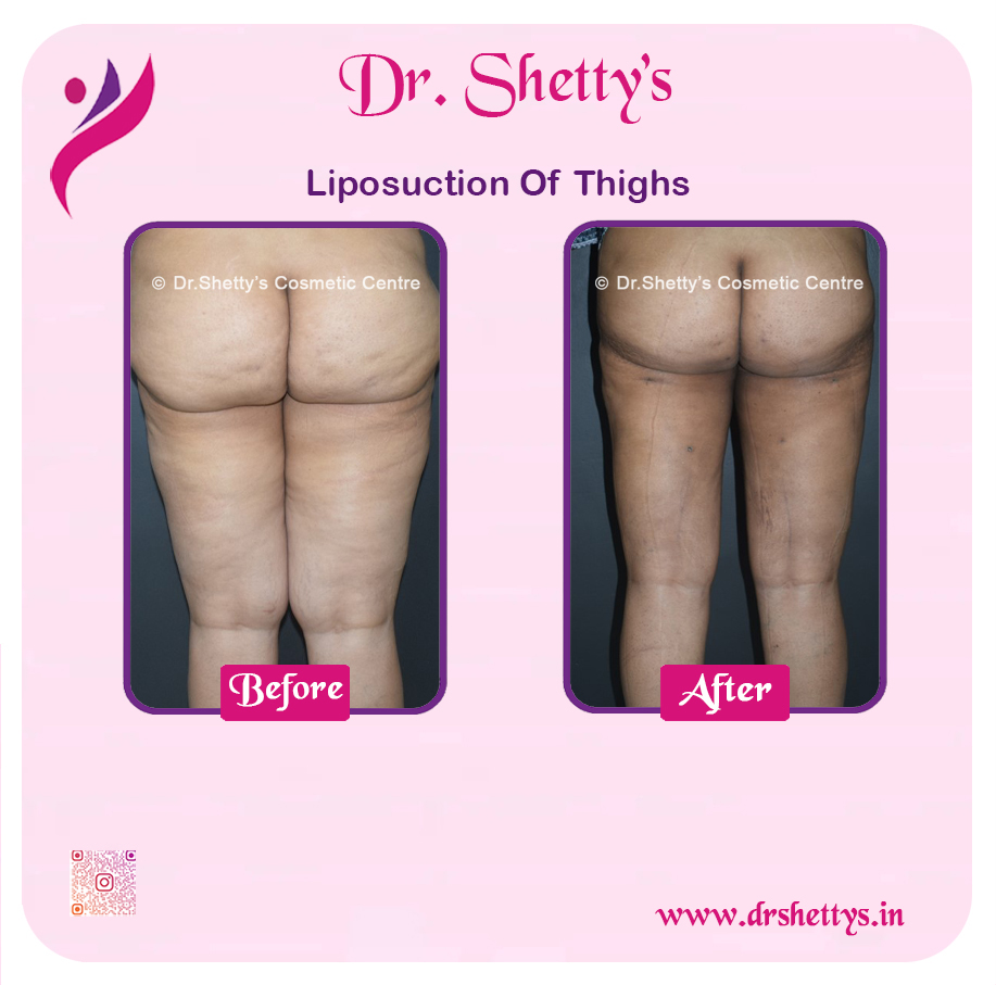 Thigh Lift Surgery 4