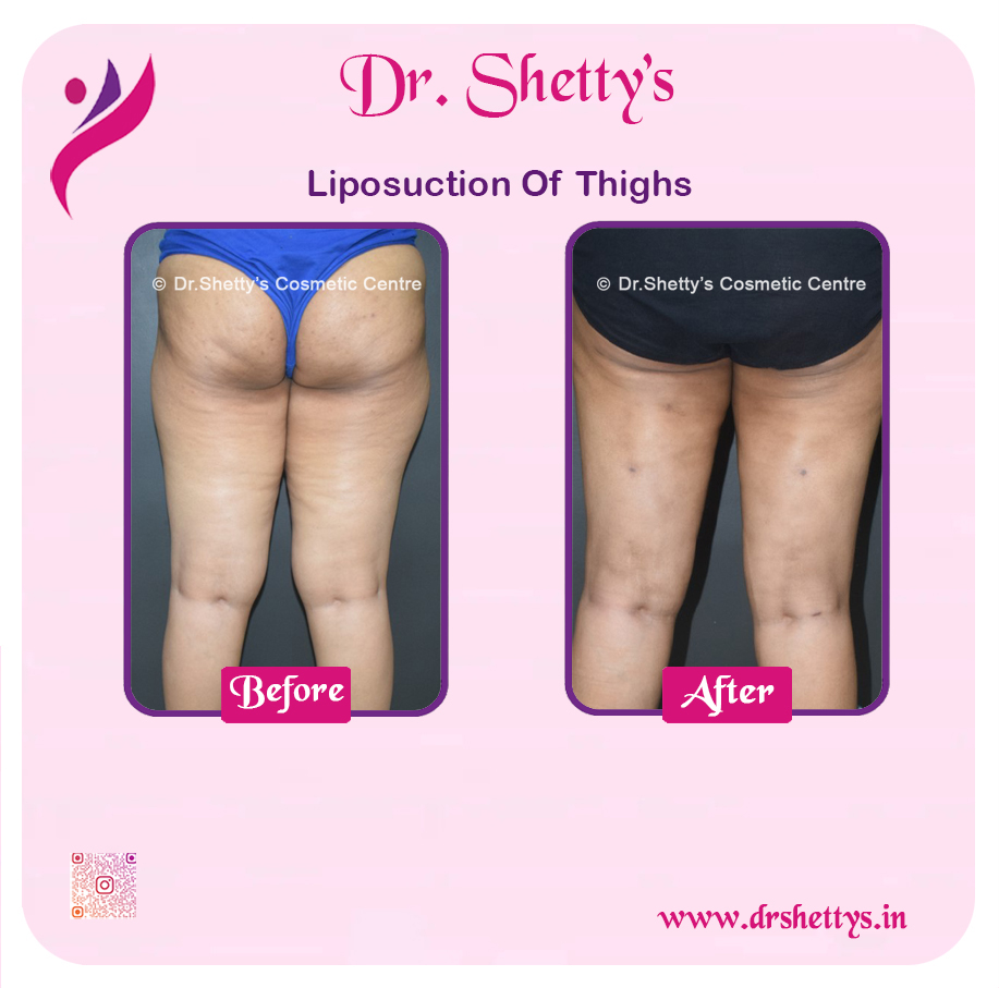 Thigh Lift Surgery 5