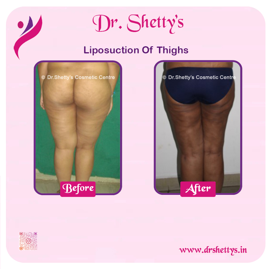 Thigh Lift Surgery 6