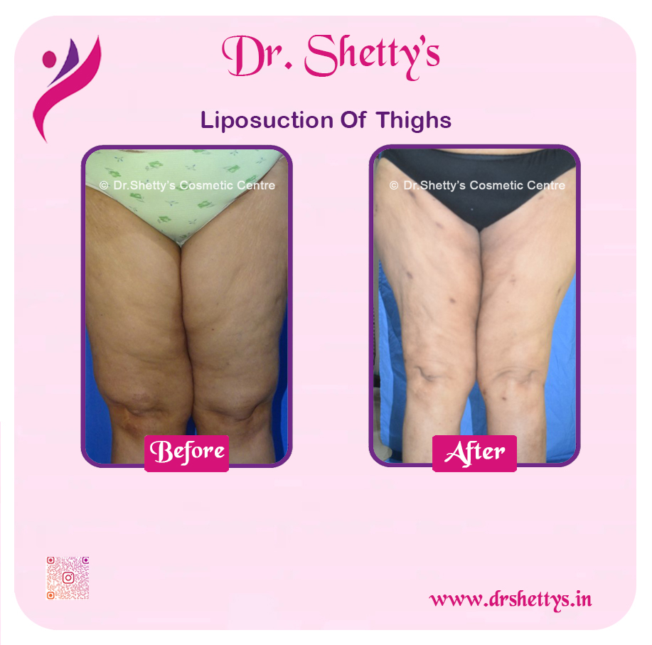 Thigh Lift Surgery 7
