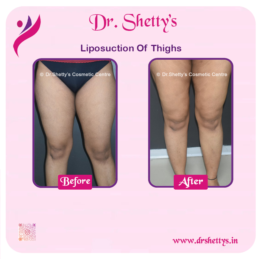 Thigh Lift Surgery 8