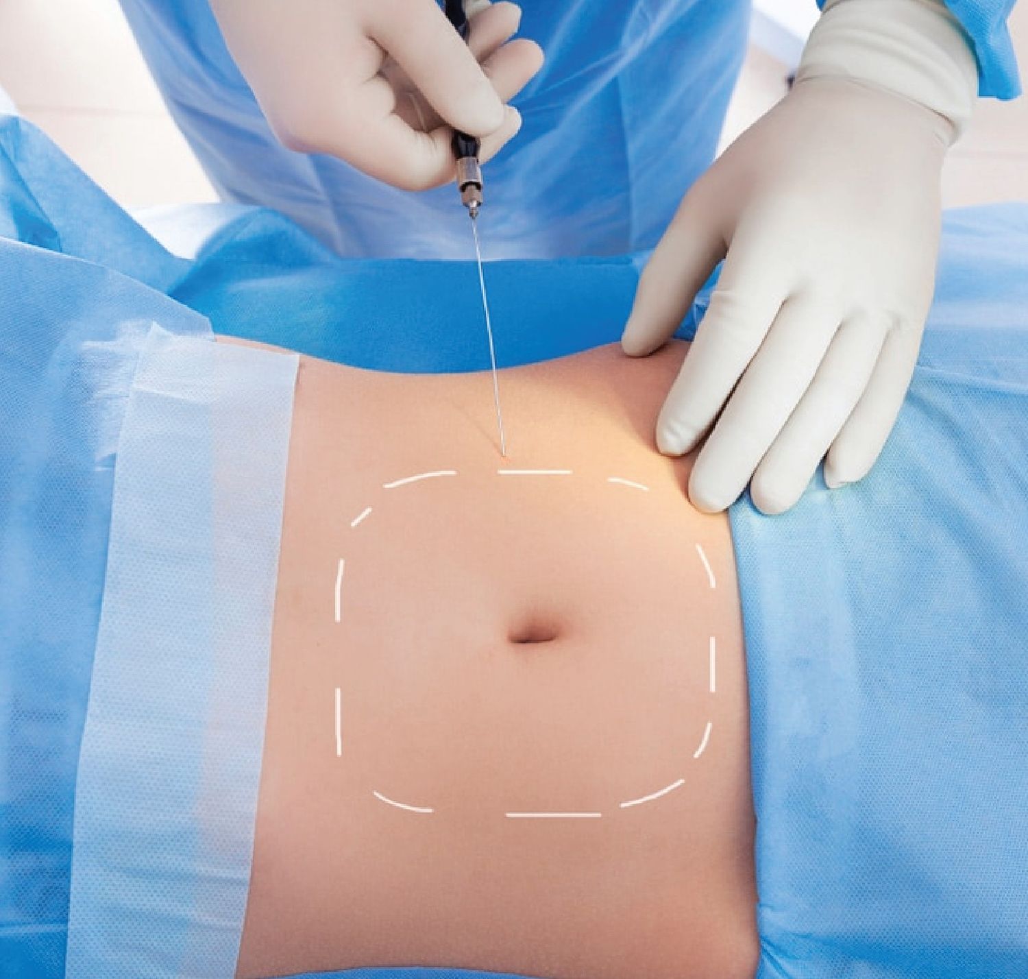 Vaser Liposuction