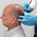 Is Hair Transplant Safe for All