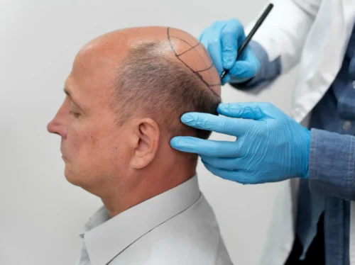 Is Hair Transplant Safe for All