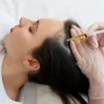PRP Hair Treatment Cost in Bangalore Average Price, Sessions & Factors