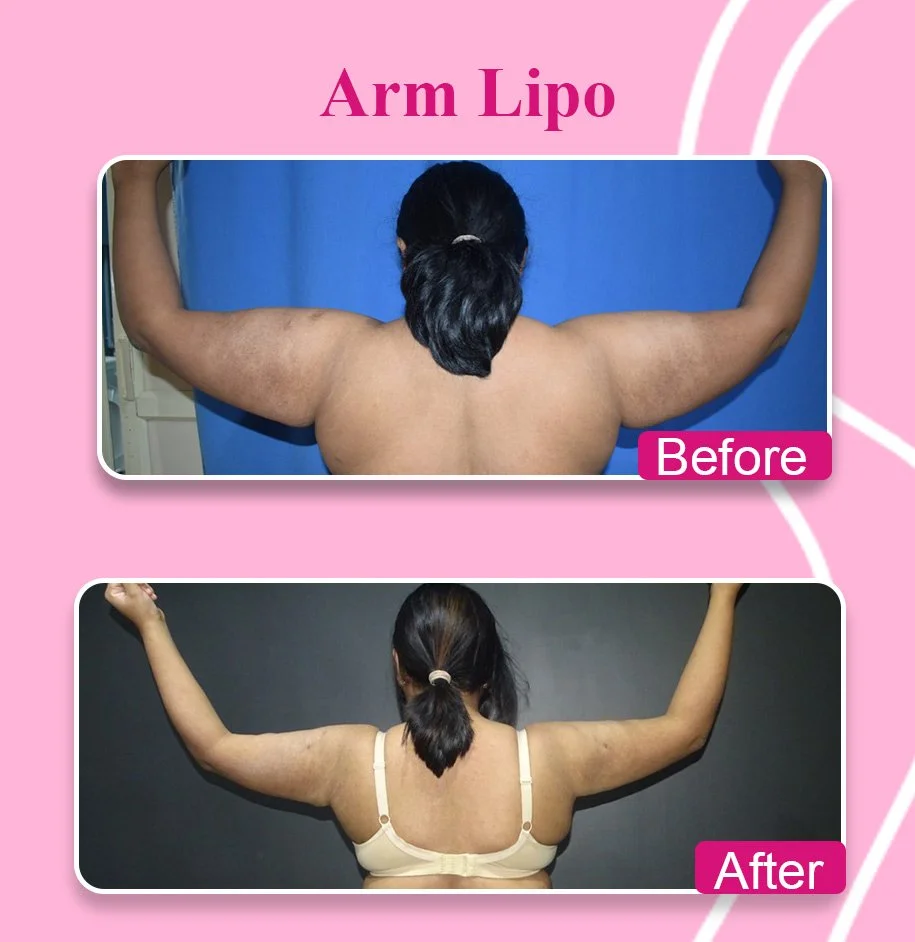 Gynecomastia Before and After