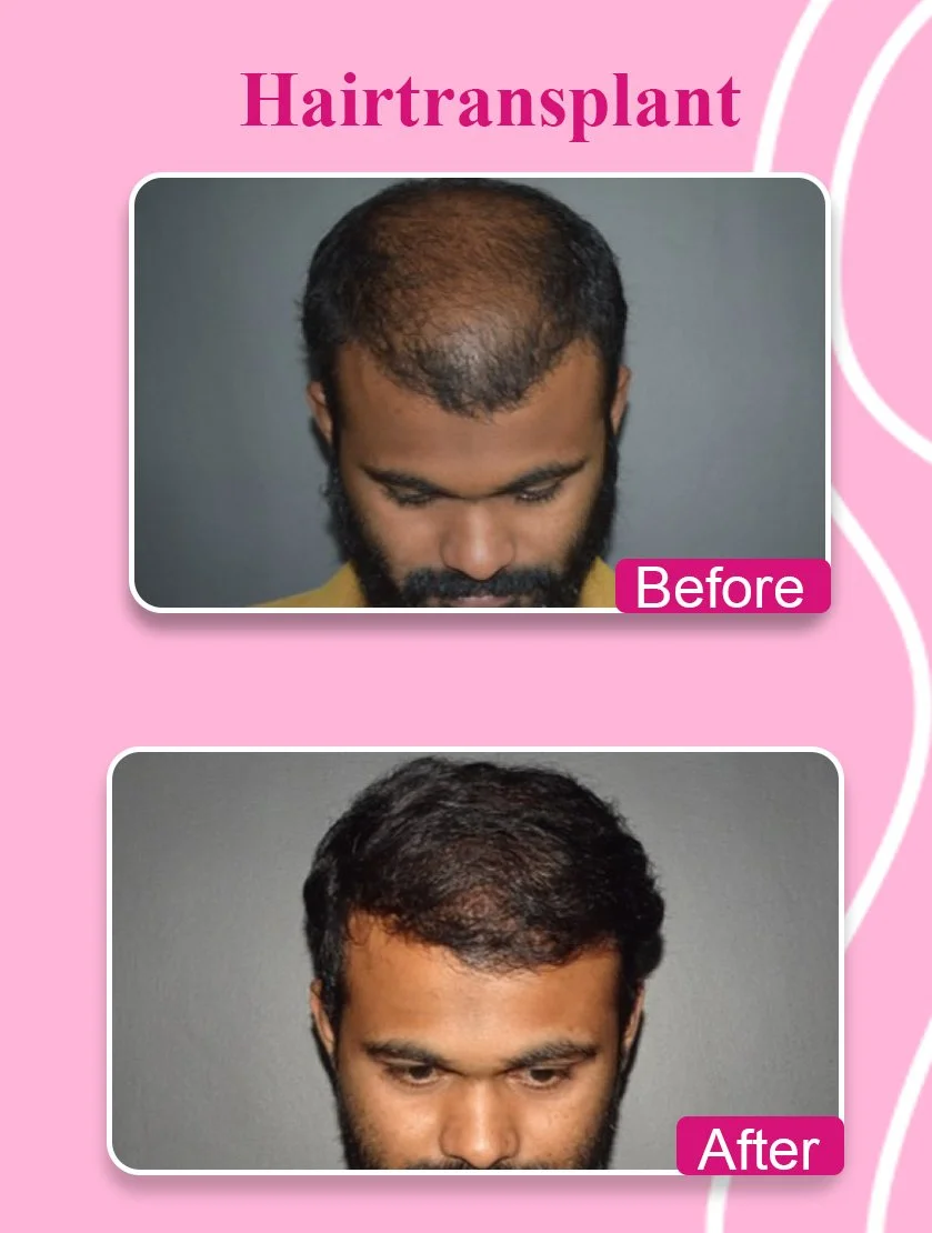 Arm Liposuction Before and After