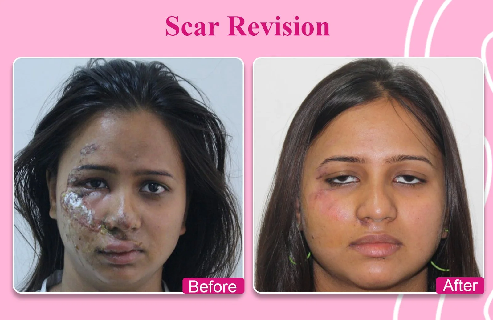 Breast Augmentation Before and After