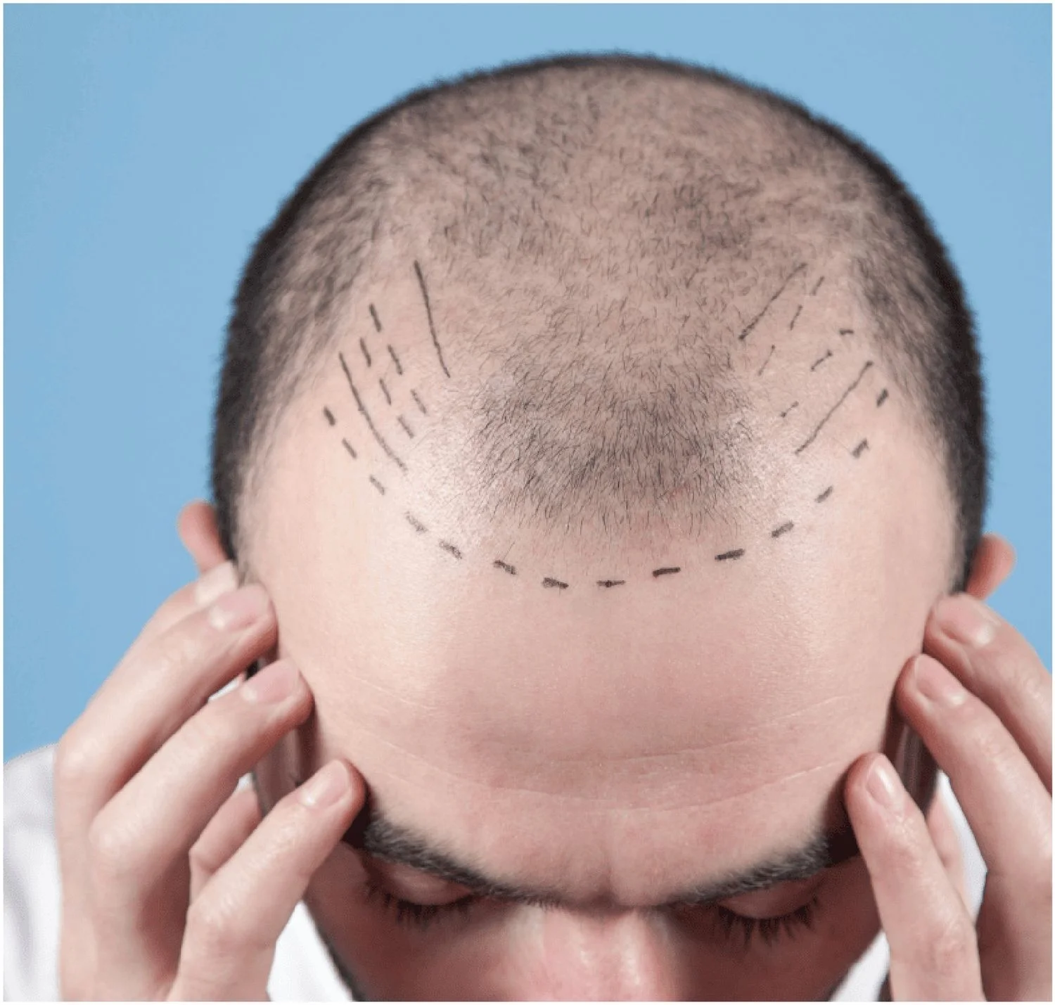 HairTransplant 2