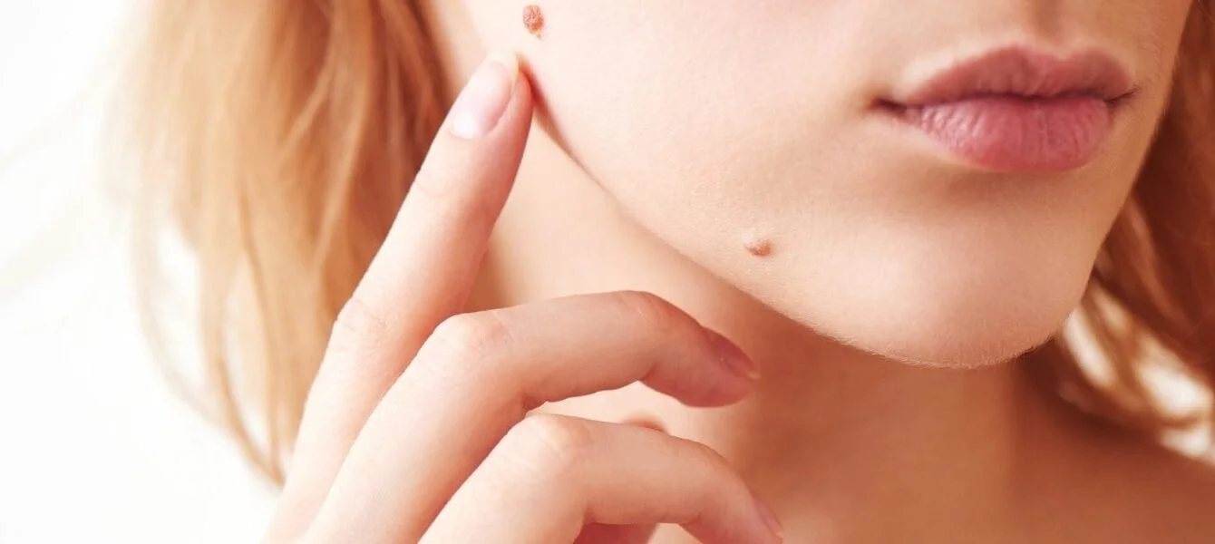 how to remove moles from your face permanently